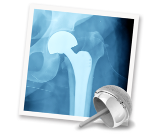 Cases_HipImplants Cases_HipImplants