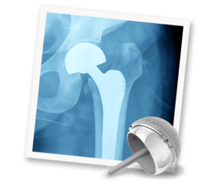 Orthopedic Hip Implants